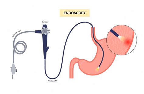 Premium Vector | Gastroscopy procedure stomach diseases diagnostic gerd ...