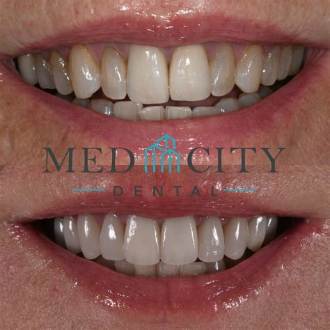 Porcelain Veneers Rochester MN | Dental Veneers | Teeth Veneers