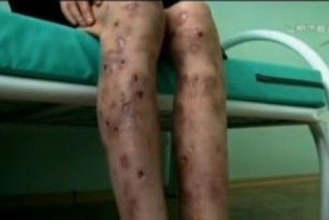 «Krokodil», l'abominable drogue qui tue 