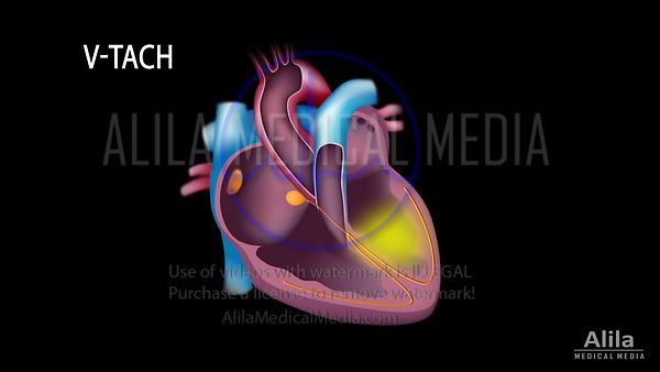 Ventricular tachycardia (V-Tach)