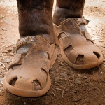 Podoconiosis, Gimbie, Ethiopia