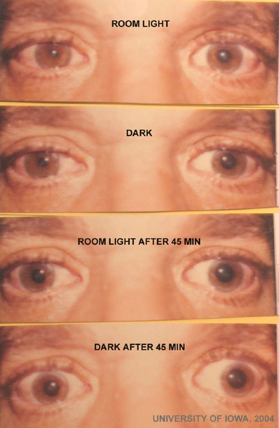  Horner's Syndrome (due to Cluster Headache)