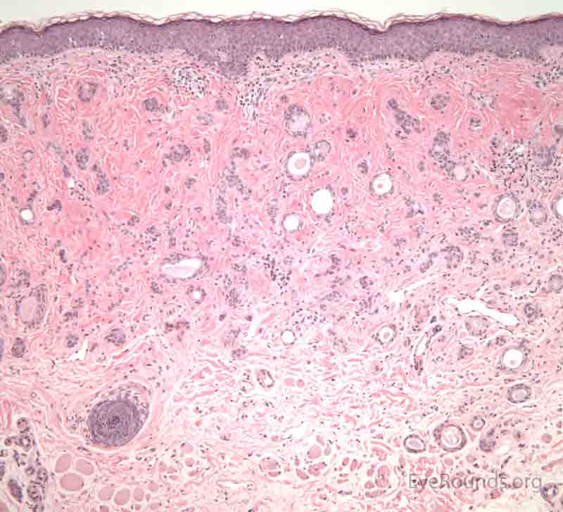 Syringoma pathology  