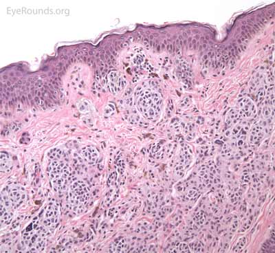 Compound nevus pathology  