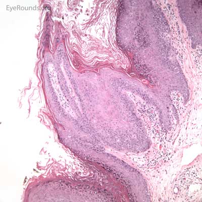 Verruca vulgaris pathology