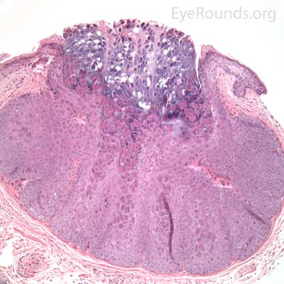 Molluscum contagiosum pathology