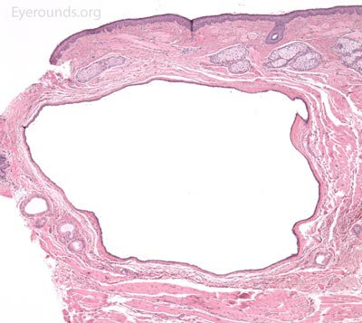 Apocrine hidrocytsoma pathology 