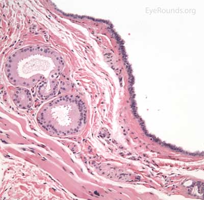 Apocrine hidrocytsoma pathology 