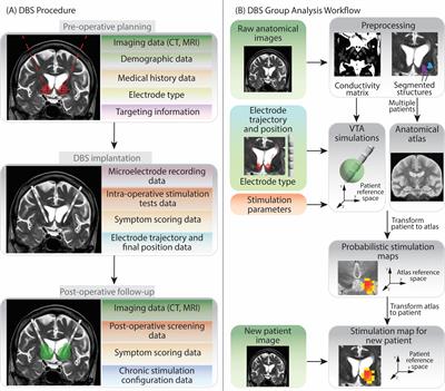 Optimizing neuroscience data management by combining REDCap, BIDS and SQLite: a case study in Deep Brain Stimulation