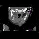 Eosinophilic granuloma of a bone: CT - Computed tomography