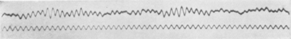 An early EEG recording by Hans Berger