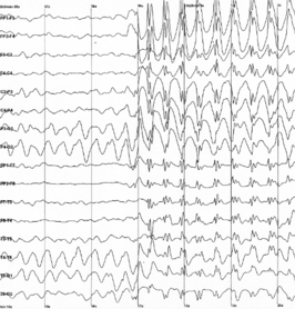 Gegeneraliseerde 3Hz 'spike & wave' ontladingen op het EEG