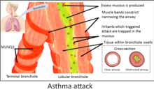 Asthma attack.PNG