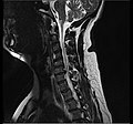 IRM cervicale sagittale montrant une hernie discale de niveau C6-C7.