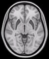 Putamenleri gösteren MRI görüntüsünün yatay kesiti. Bazal gangliyonun diğer çekirdekleri (kaudat çekirdek ve globus pallidus) da görülüyor.