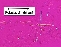 Uric acid crystals in polarized light, showing negative birefringence, with yellow color when aligned parallel to the axis of the red compensator, and blue when aligned perpendicularly to it.[59]